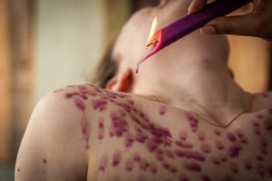 Purple wax dripped onto person's skin from candle.