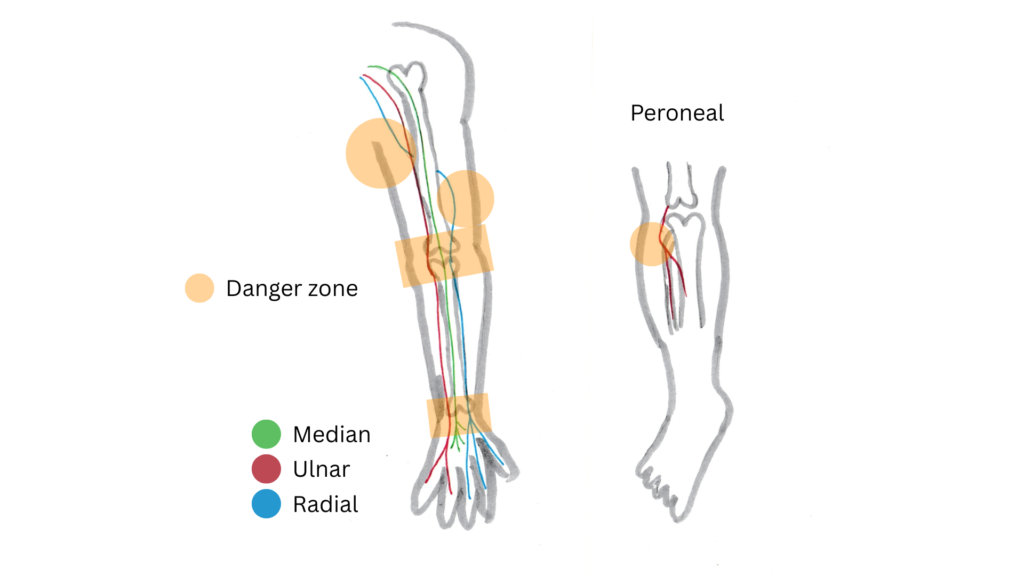 Diagram of arm and leg nerve danger zones